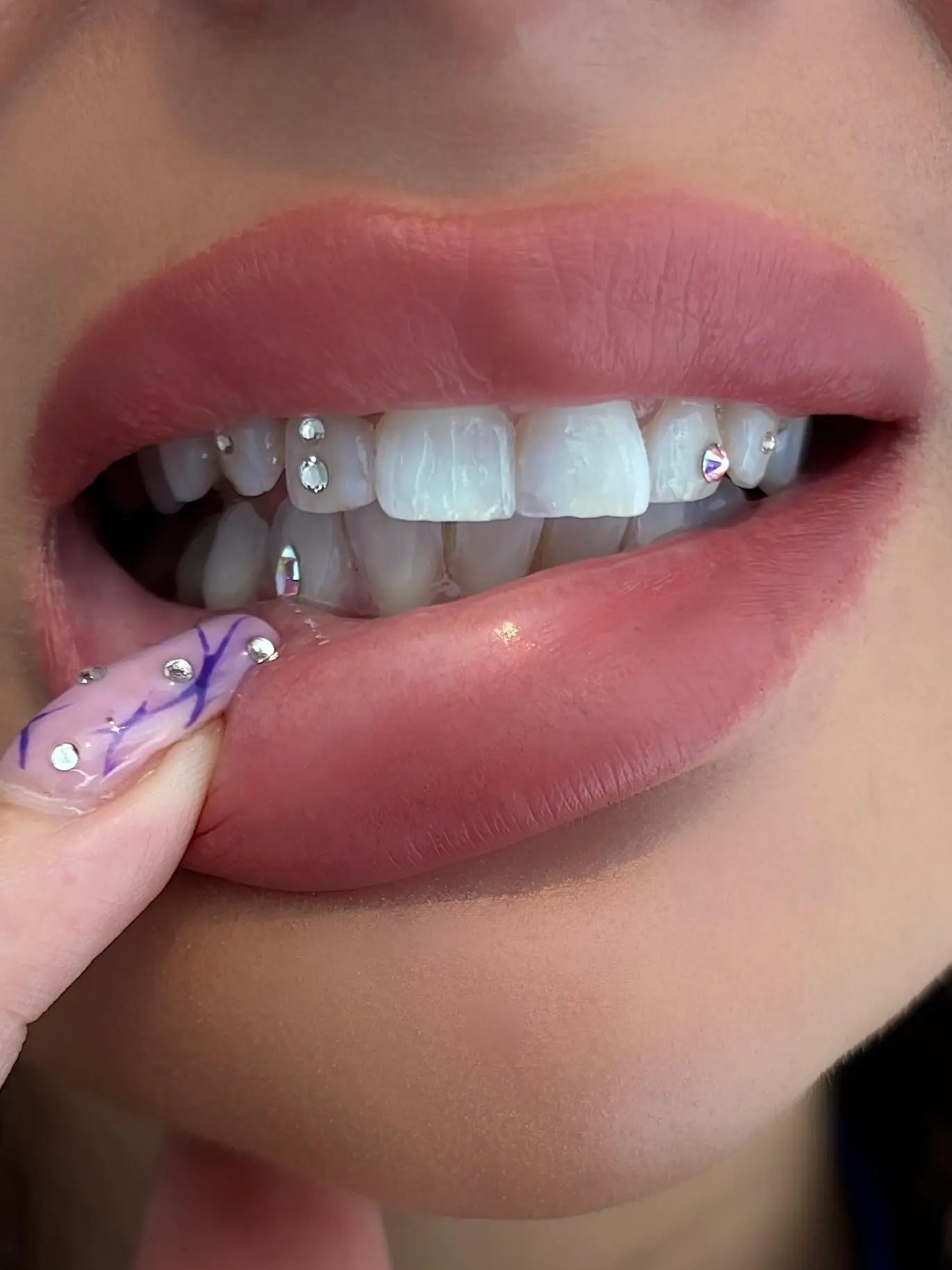 Tooth gems på tænder med diskret og kreativt design