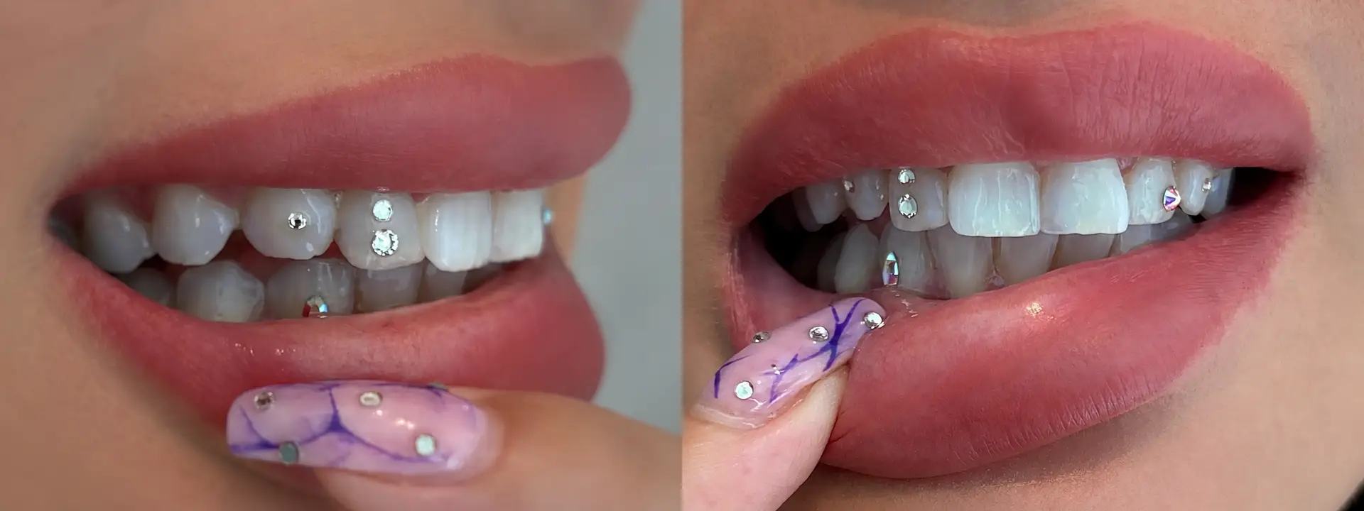 To tooth gem-designs med flere tandsmykker og tandjuveler på tænderne vist side om side.